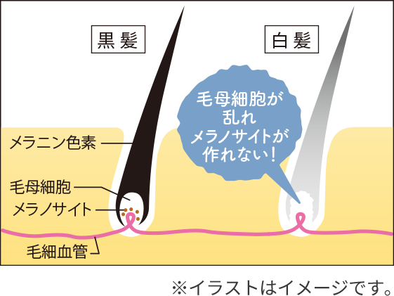 毛母細胞が乱れメラノサイトが作れない！